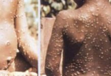 Le Royaume-Uni enregistre chaque jour de nouveaux cas de variole du singe