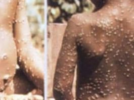 Le Royaume-Uni enregistre chaque jour de nouveaux cas de variole du singe